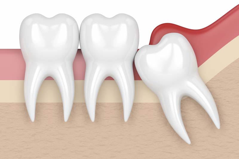 Wisdom Tooth Removal in Compton